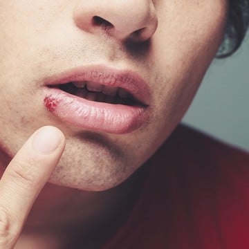 This Guy Is Suing A Tinder Hookup Who Gave Him Herpes. Ouch For Everyone.